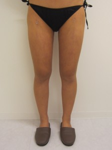 ①術後1か月　正面